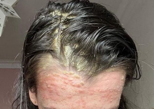 Nikki Scalp Psoriasis