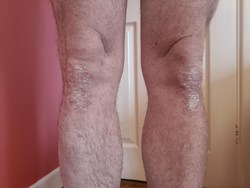 Ben psoriasis