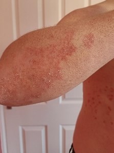 Ben psoriasis